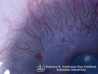 Diffuse conjunctival intraepithelial neoplasm with corneal invasion, simulating a peripheral inflammatory lesion with pannus.